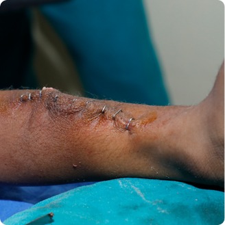 Leg surgery stitches