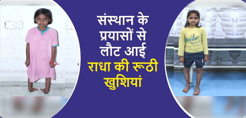 Radha's Triumph: Overcoming Polio Struggles | Narayan Seva Sansthan