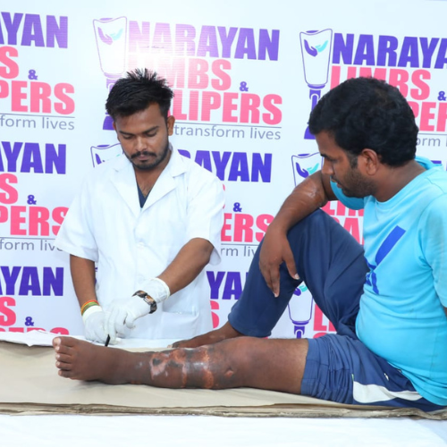 Narayan Limb Distribution Camp Jaipur 001